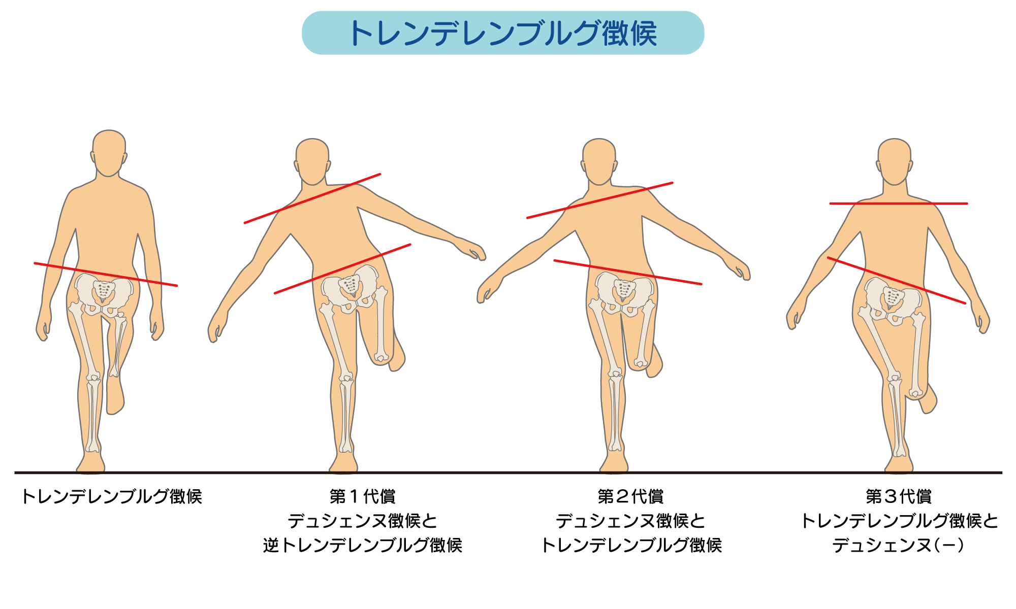 中臀筋を鍛えて歩行や片足立を安定させよう 中臀筋の役割とトレーニング Ayumi Eye